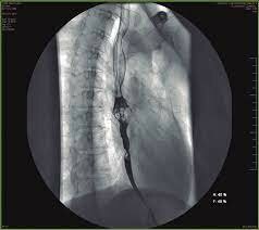 PRIMERA BRAQUITERAPIA ENDOLUMINAL