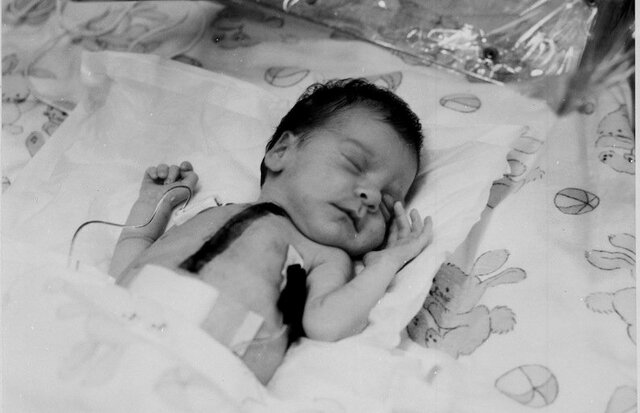 Baboon Heart Transplant