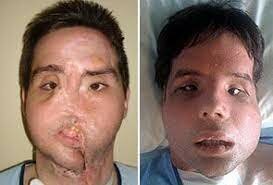 First Full Face Transplant