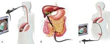 Endoscopic Surgery