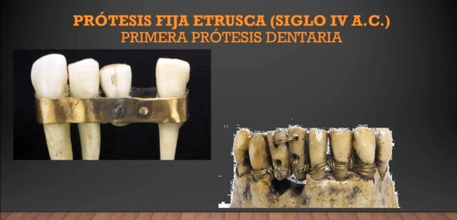 PROTESIS FIJA ETRUSCA