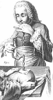 La trepanación o craneotomía