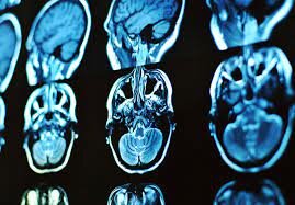 Neuropsicología dinámica