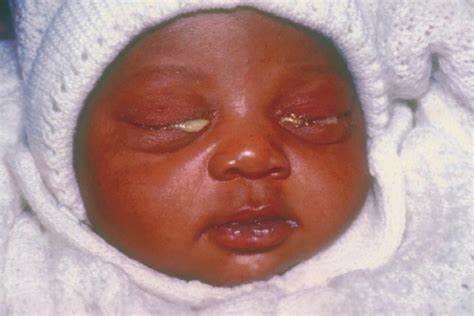 Primer Congreso Mexicano de Prevencion de la ceguera