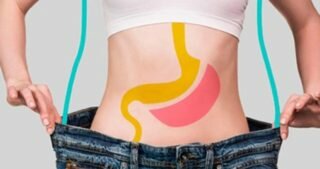 Cirugía bariátrica