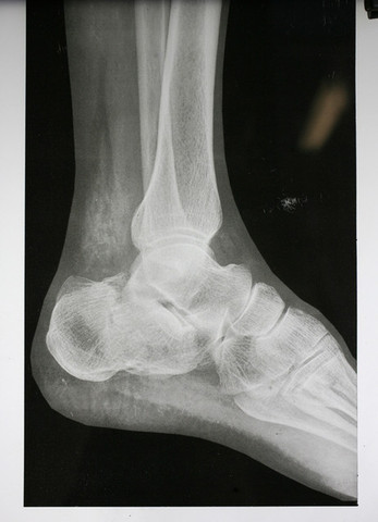 Wilhelm Roentgen discovers X-rays