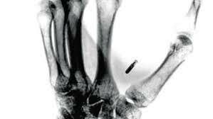 Microchip que se implanta dentro de la pie para saber la historia de salud