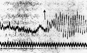 electroencefalografia