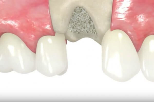 Goldman, Se establecieron dos causas de enfermedad peridontal: una condición local supuestamente causada por factores locales y otra, una atrofia del hueso alveolar debida a una causa desconocida