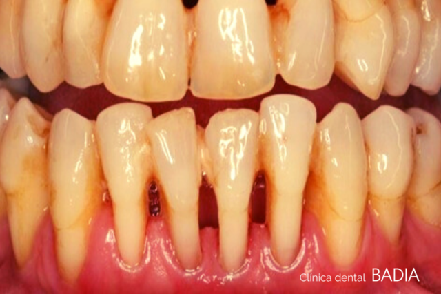 McCall: prólogo en Miller:  la piorrea “se trata de una afección curable”