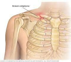 I bent my clavicle and I thought I broke it