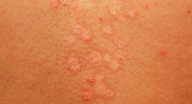 PITIRIASIS VERSICOLOR