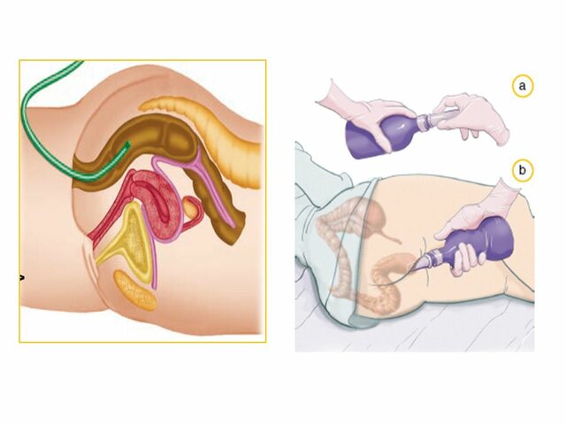 Aporte nutricional por vía rectal.