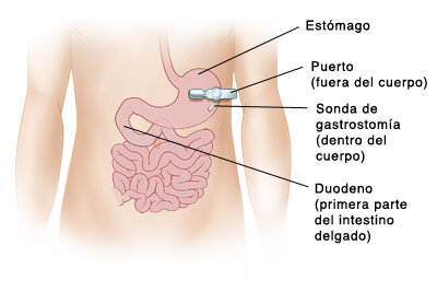 Nutrición nasoduodenal