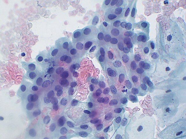 Primer tinción triple reportada.