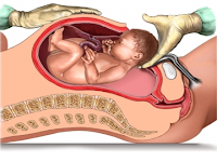 Cesárea (edad moderna)