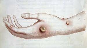 Creación de una Vacuna (viruela)