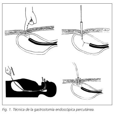 Gastrostomía endoscópica percutánea y la técnica de implantación