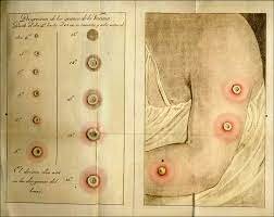 Vacuna Contra la Viruela