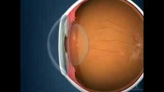 Sistema Oftalmológico de Levinshon.