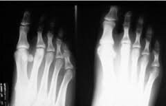 Sistema Radiográfico de Levinshon.