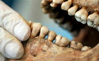 1779.  Primera identificación dental