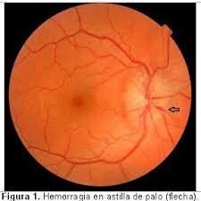 Sistema oftalmológico de Levinshon