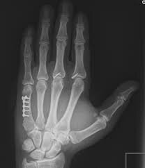 Sistema radiográfico de Levinshon