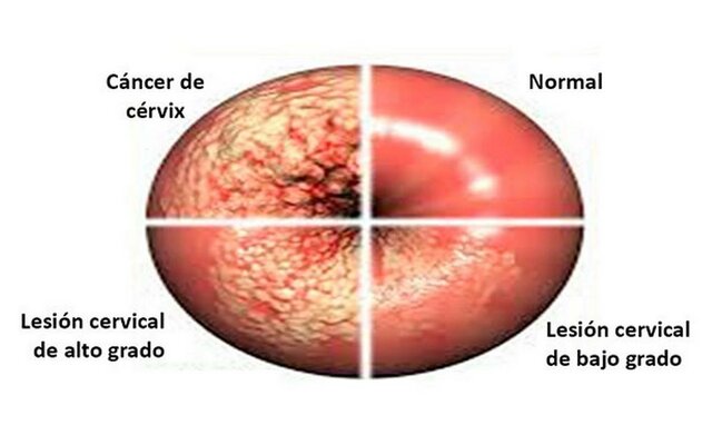 Prueba de Papanicolaou