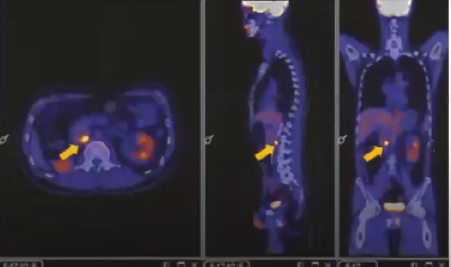 La Tomografía por Emisión de Positrones (PET) se utiliza de forma habitual ens ervicios clínicos