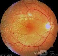 Coagulación pan-retiniana