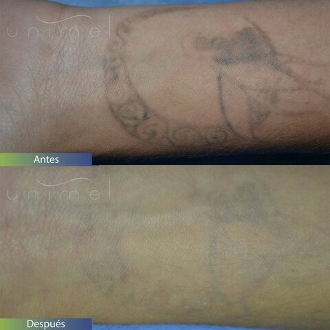 Eliminación de tatuajes con láser