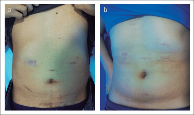 Trasplante de hígado de donante vivo adulto