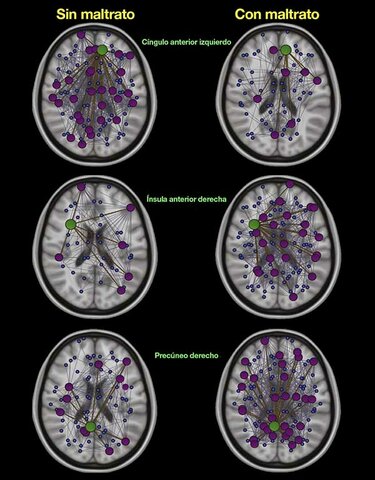 Anomalías cerebrales asociadas con el abuso y la negligencia.