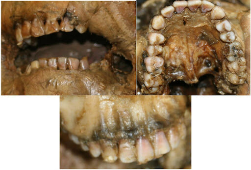 Odontología Forense