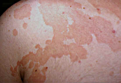 PITIRIASIS VERSICOLOR-Eichstedt