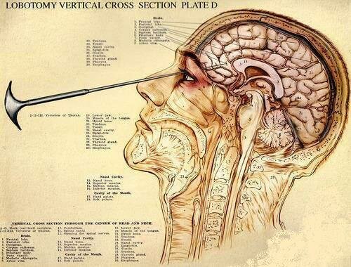 LOBOTOMIA Y LEUCOTOMÍA