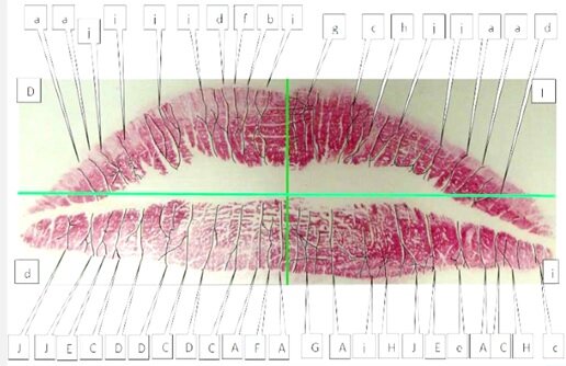 Surcos Labiales, Fischer