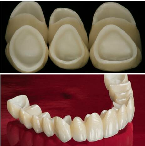 Introducción de restauraciones de cerámica sin metal