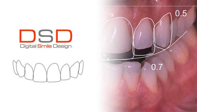 Diseño digital de la sonrisa (DSD)