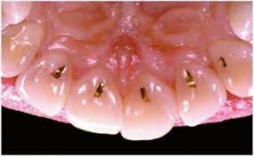 Lamina de oro cohesiva