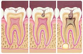 Teoría Quimicobacteriana
