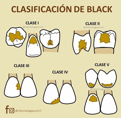 Preparación de cavidades