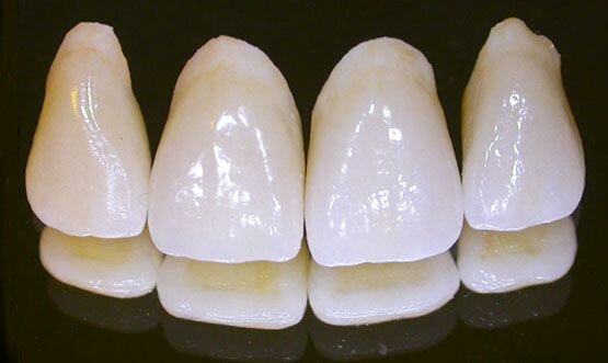 Corona de porcelana de cerámica