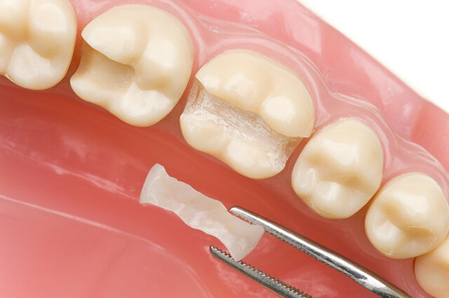Sistema de incrustaciones cerámicas Cerec®