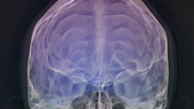 Epilepsia- Esquizofrenia