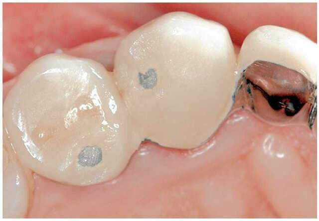 Sistema Metal Cerámica