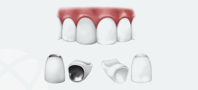 Primera all-ceramic porcelain jacket crown