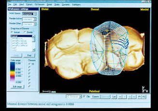 CICERO system (computer integrated crown Reconstruction)