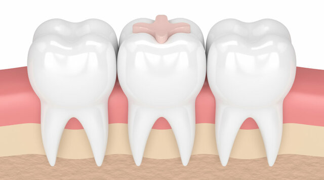 Primera incrustación cerámica inlay
